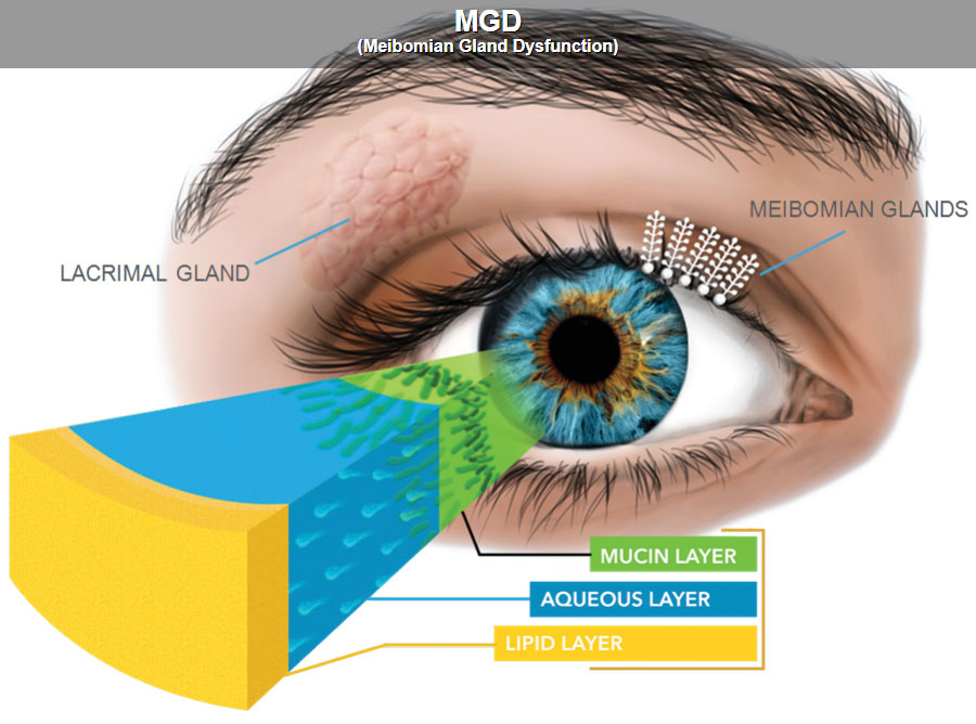 dry eye treamtment lipiflow